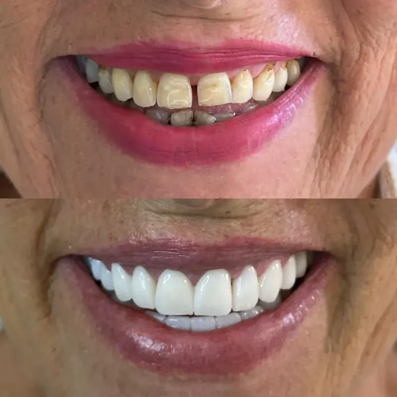 Corone in zirconio